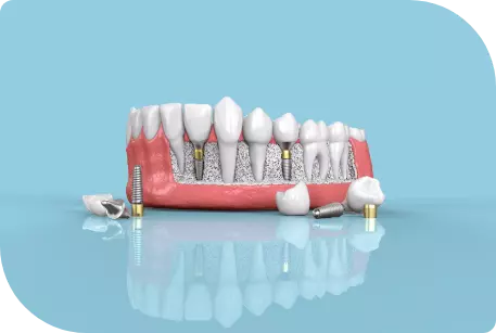 Dental Zygomatic Implants